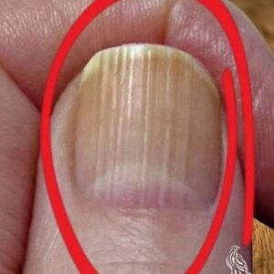Having Striped Nails Could Mean That Your Body is!